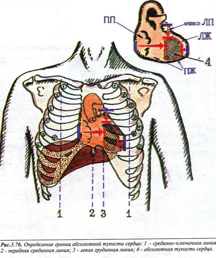 Границы абсолютной. Границы абсолютной тупости сердца. Тупость сердца. Верхняя граница относительной сердечной тупости. Левая граница относительной сердечной тупости.