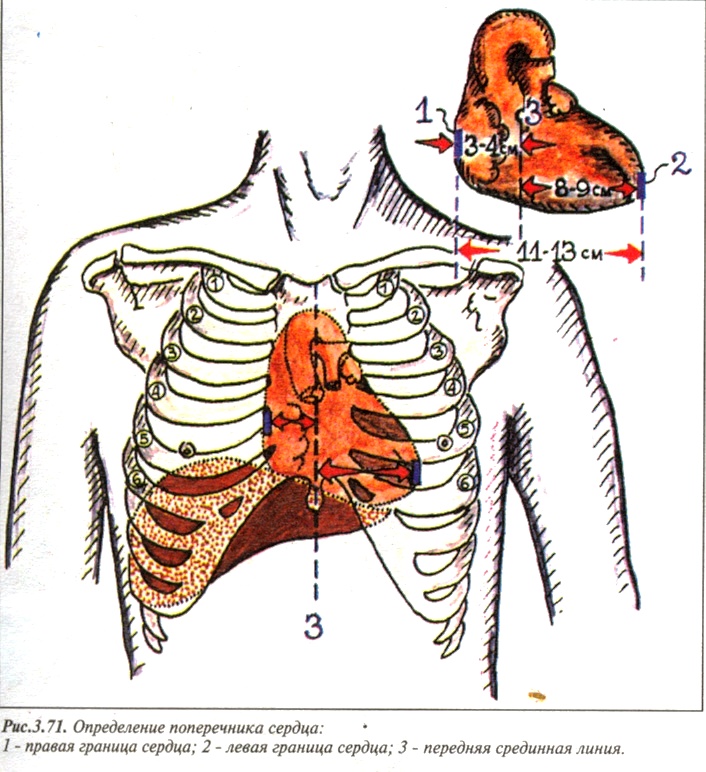 Длинник сердца. Поперечник сердца перкуссия. Поперечник относительной тупости сердца в норме. Измерение поперечника относительной тупости сердца. Границы относительной тупости сердца поперечник.