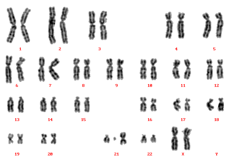 Кариограмма графическое изображение кариотипа то есть числа. Синдром де груши кариотип. Синдром Эдвардса кариограмма а3. Кариограмма с наследственной патологией. Кариограмма ХМЛ.