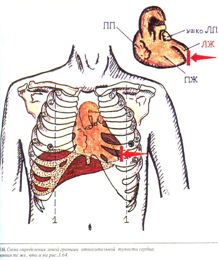 Определение сердечной тупости. Границы относительной тупости сердца перкуссия. Левая граница относительной тупости сердца. Перкуссия сердца Относительная тупость сердца. Относительная граница сердца перкуссия.