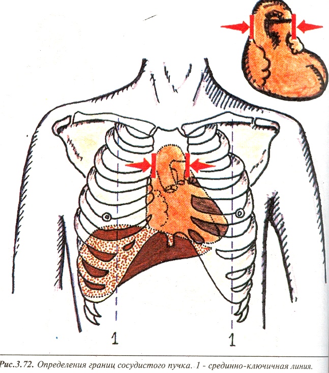 Сосудистый пучок. Аускультация сердца сосудистого пучка. Границы сосудистого пучка. Границы сосудистого пучка в норме. Границы сосудистого пучка сердца.