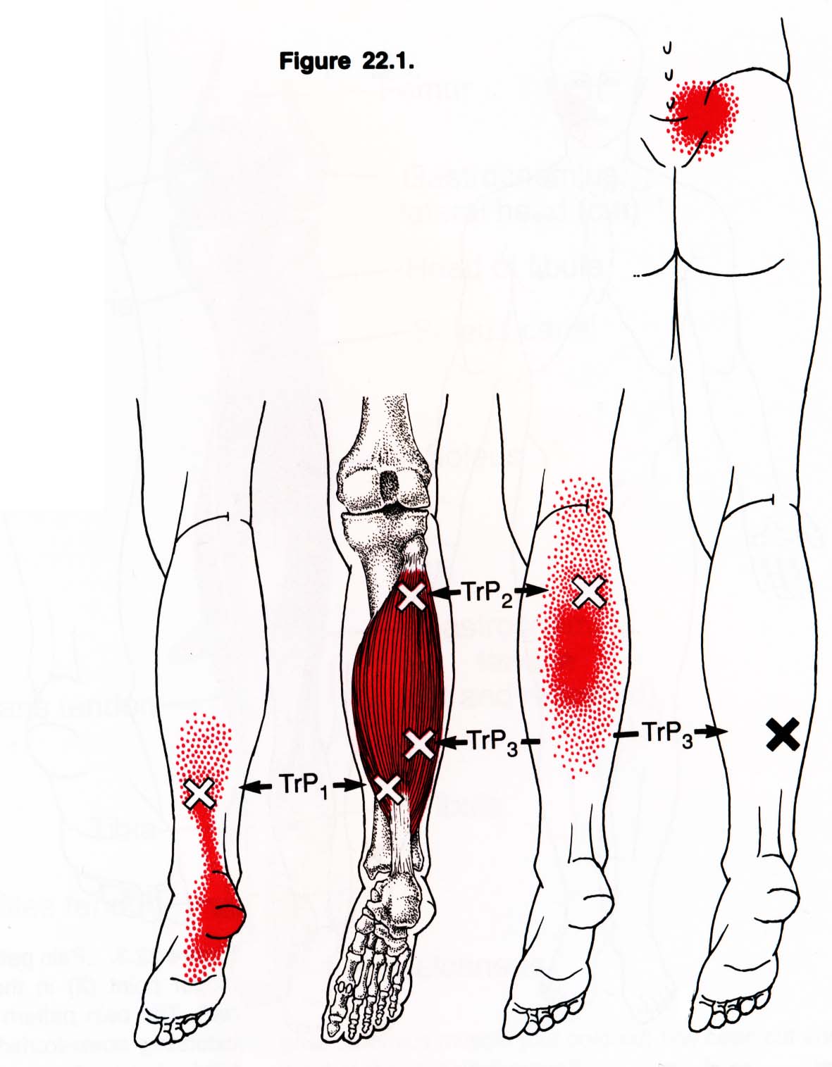 Боль в икрах ног у мужчин. Триггерные точки икроножной мышцы. Триггерные точки мышц голени. Триггерные точки камбаловидной мышцы. Триггерные точки большеберцовой мышцы.