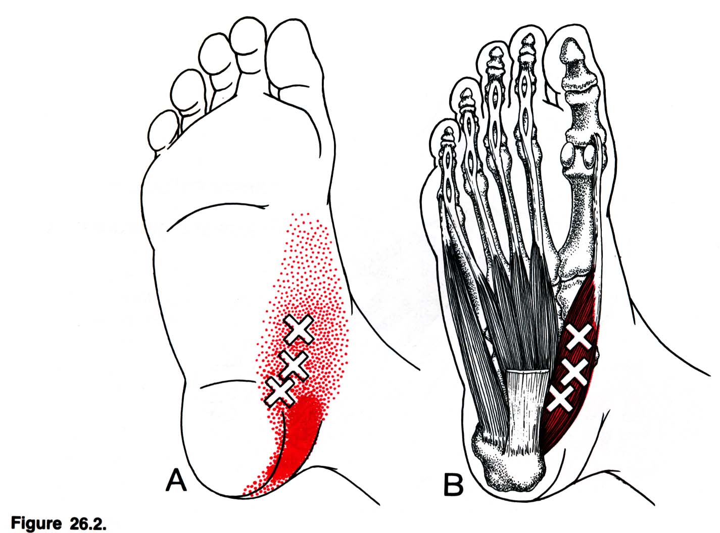 Foot muscle. Триггерные точки мышц стопы. Abductor Hallucis мышца. Триггерные точки голеностопного сустава. Триггерные точки боль в стопе.