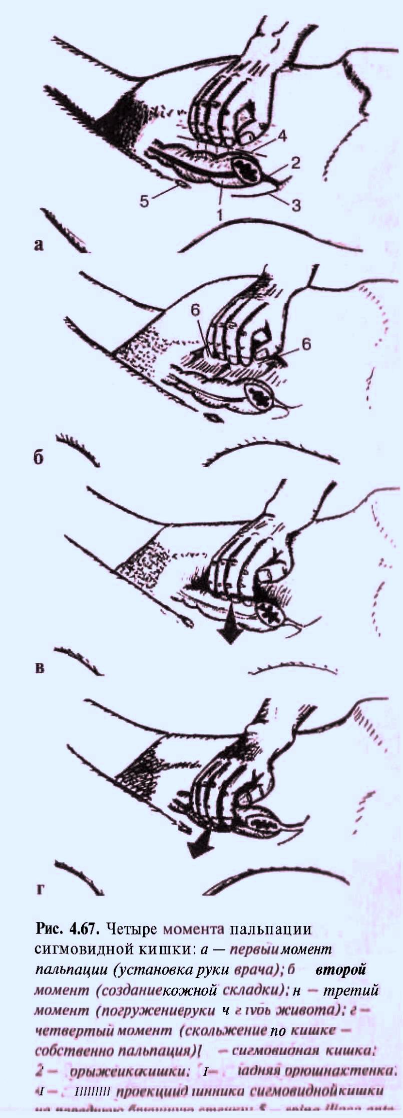 Бимануальное влагалищное исследование. Пальпация поперечной ободочной. Глубокая пальпация сигмовидной кишки. Пальпация сигмовидной. Пальпация поперечно ободочной кишки.