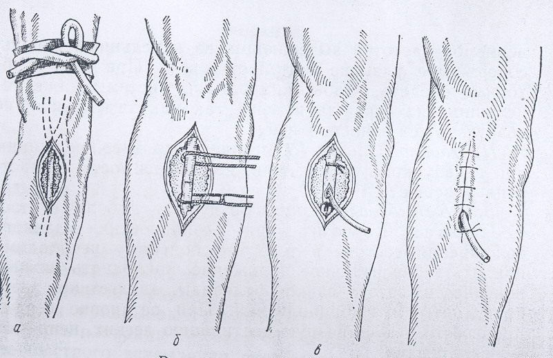 Перевязка подкожных вен. Катетеризация бедренной вены техника. Катетеризация бедренной вены по Сельдингеру техника пункция. Пункция бедренной вены. Паховая Вена катетеризация.