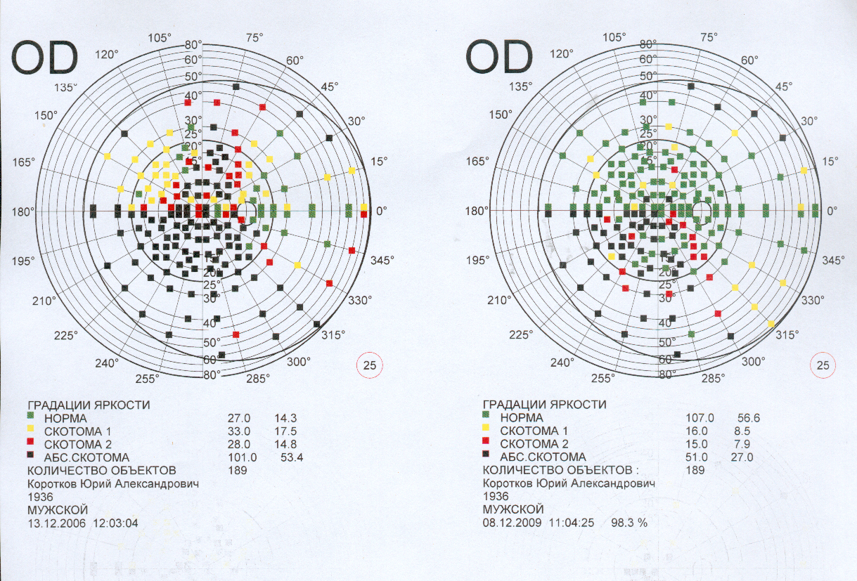 Периметрия расшифровка. Периметрия поля зрения скотома 1. Периметрия поля зрения норма. Исследование полей зрения периметрия норма. Статическая периметрия Центральная скотома.