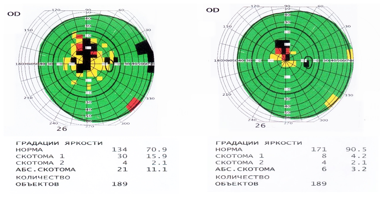 Процедура поле зрения. Периметрия расшифровка результатов. Компьютерная периметрия Результаты. Компьютерная периметрия интерпретация результатов. Компьютерная периметрия расшифровка результатов.